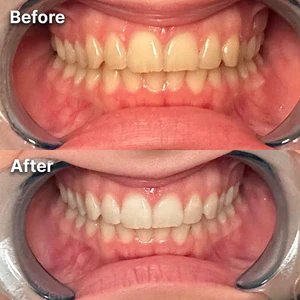 Dr Dent Teeth Whitening Strips (7x pairs per pack) - Image 2